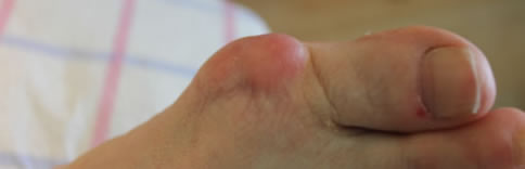 Bunions