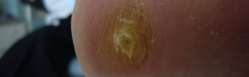 A corn on the sole of the foot before treatment