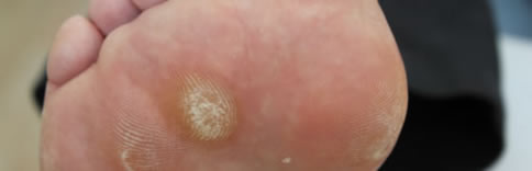 Corns & Callous