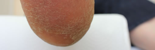 Heel Fissures (cracked heels)