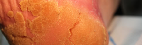 Heel Fissures (cracked heels)