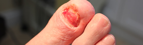 Ingrowing Toenails