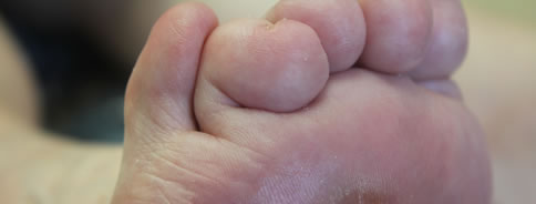 Retracted Toes