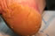 Heel Fissures 