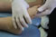 Morton's Neuroma