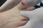 Hallux Limitus