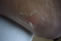 Blisters