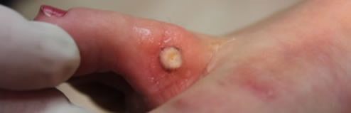 Cryosurgery